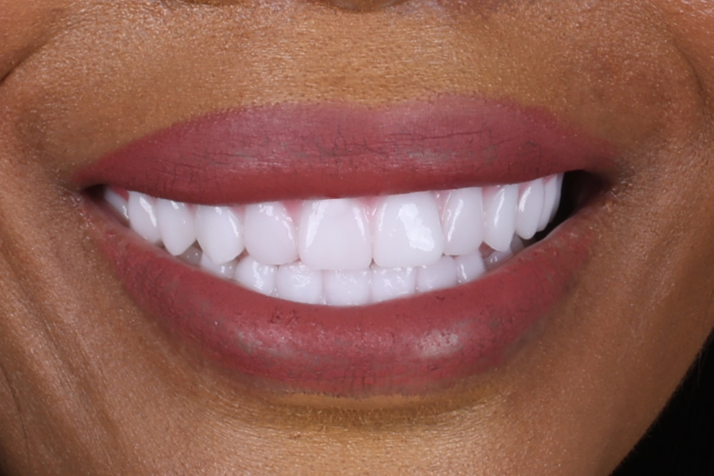 After smile patient 10