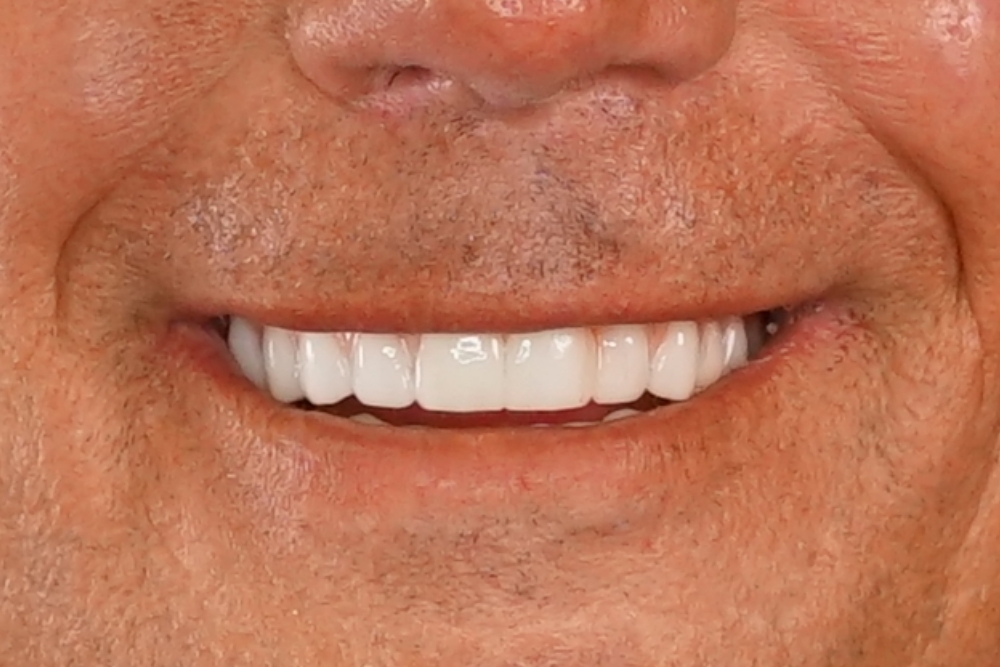 After smile patient 11