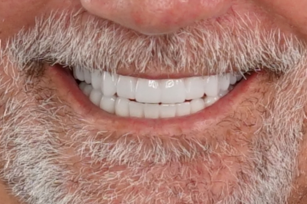 After smile patient 12