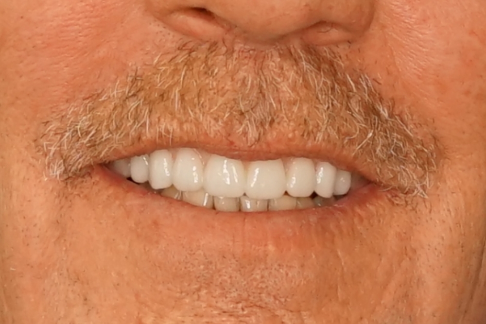 After smile patient 13