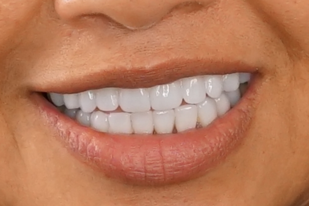 After smile patient 14