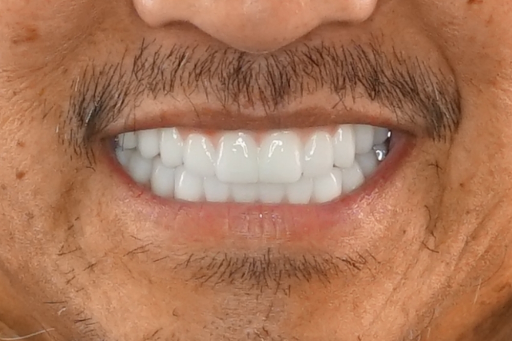 After smile patient 15