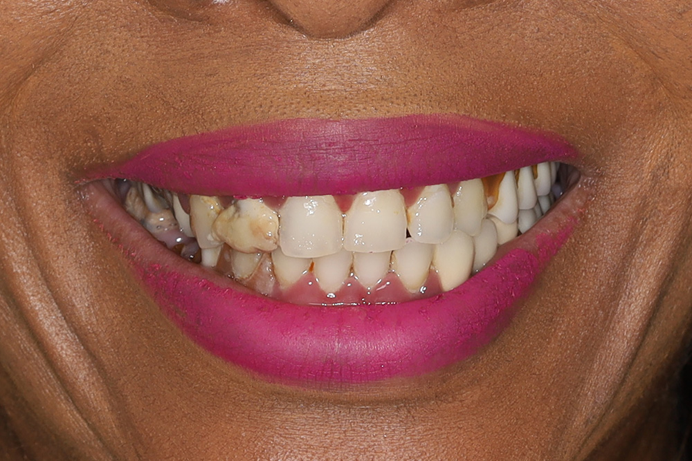 Before smile patient 10