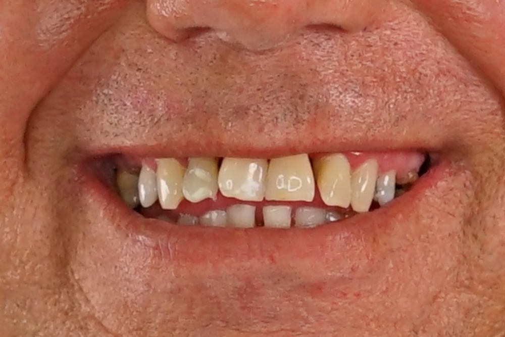 Before smile patient 11