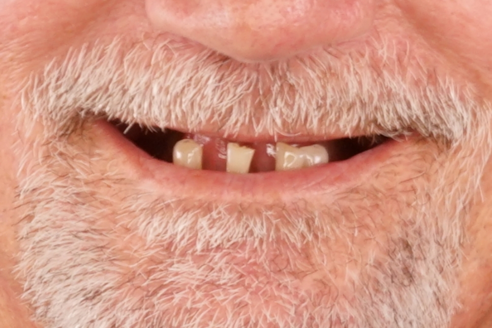 Before smile patient 12