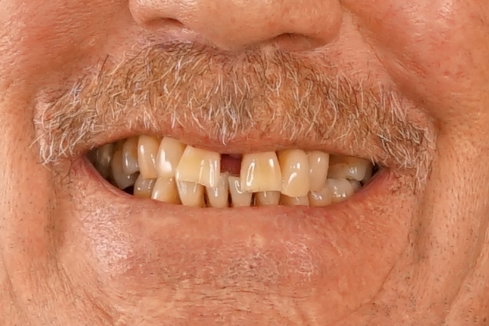 Before smile patient 13