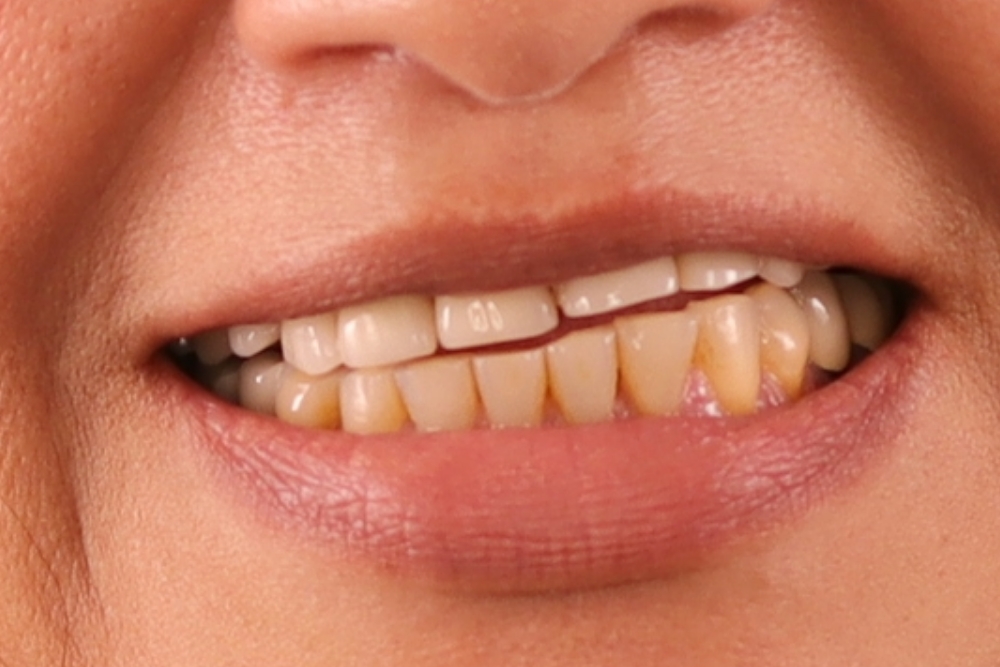 Before smile patient 14