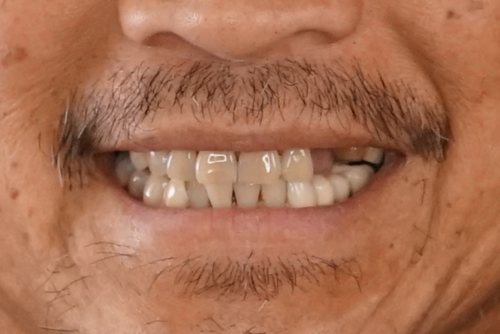 Before smile patient 15